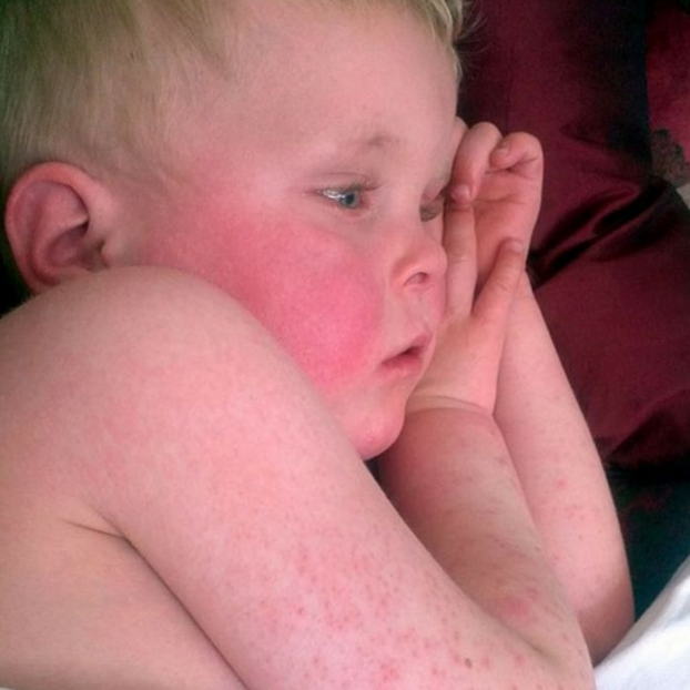 17-common-skin-rashes-in-children-dailyhealthtips