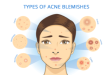Different Types of Acne & Best Cream to Treat Them
