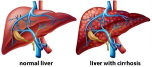 Cirrhosis