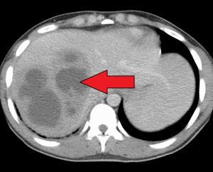 Liver Abscess