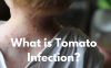 Tomato Infection – What It Causes, It’s Symptoms and How to Treat It?